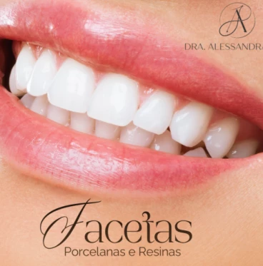 Imagem Facetas de Resina e Porcelana
