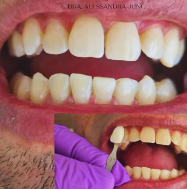 Imagem Clareamento Dental